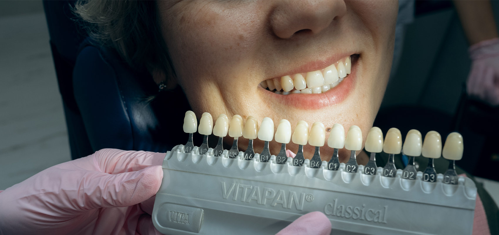 Zoom 4: плюсы и минусы отбеливания зубов по современной технологии