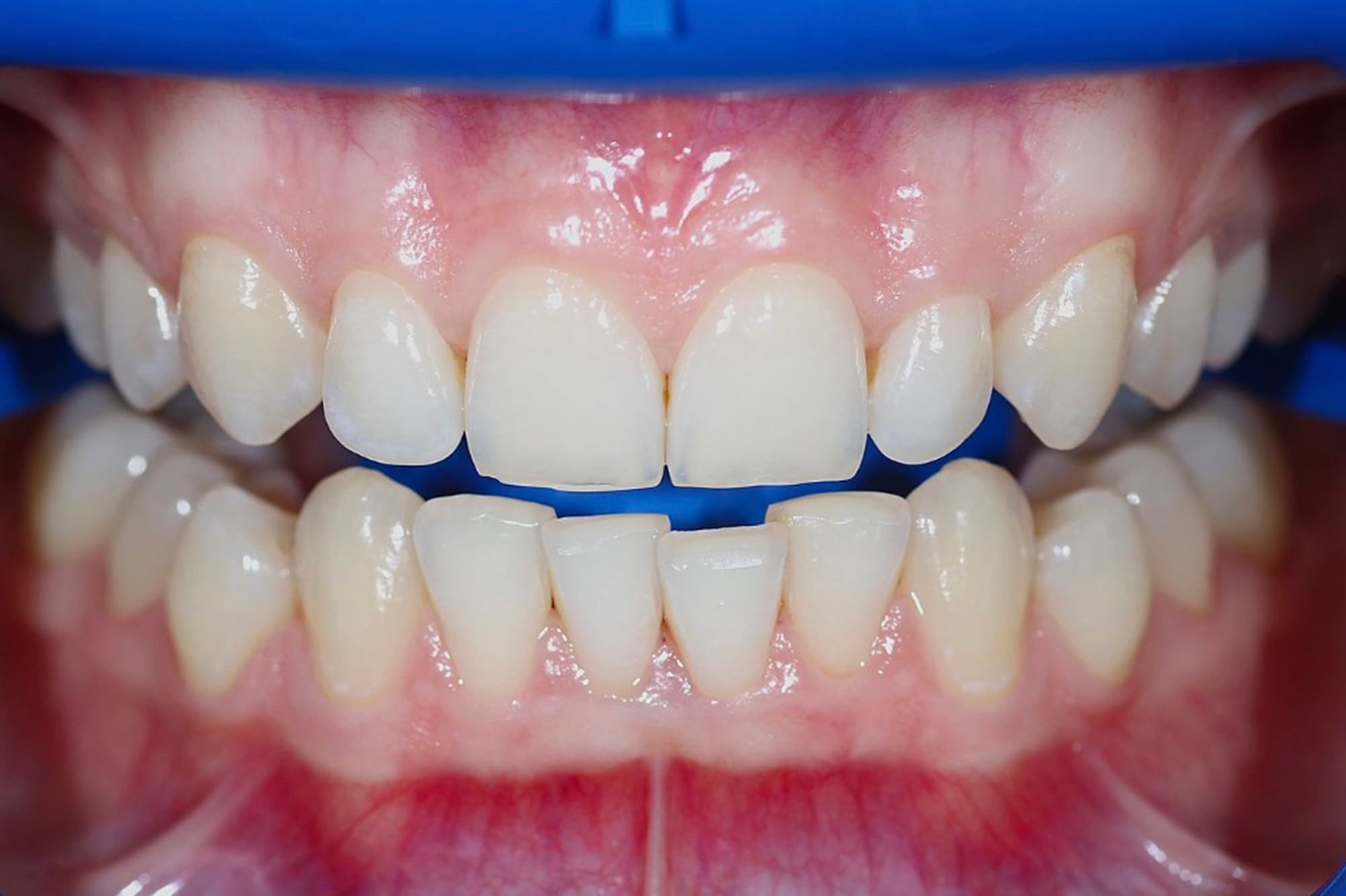 Лазерное отбеливание до