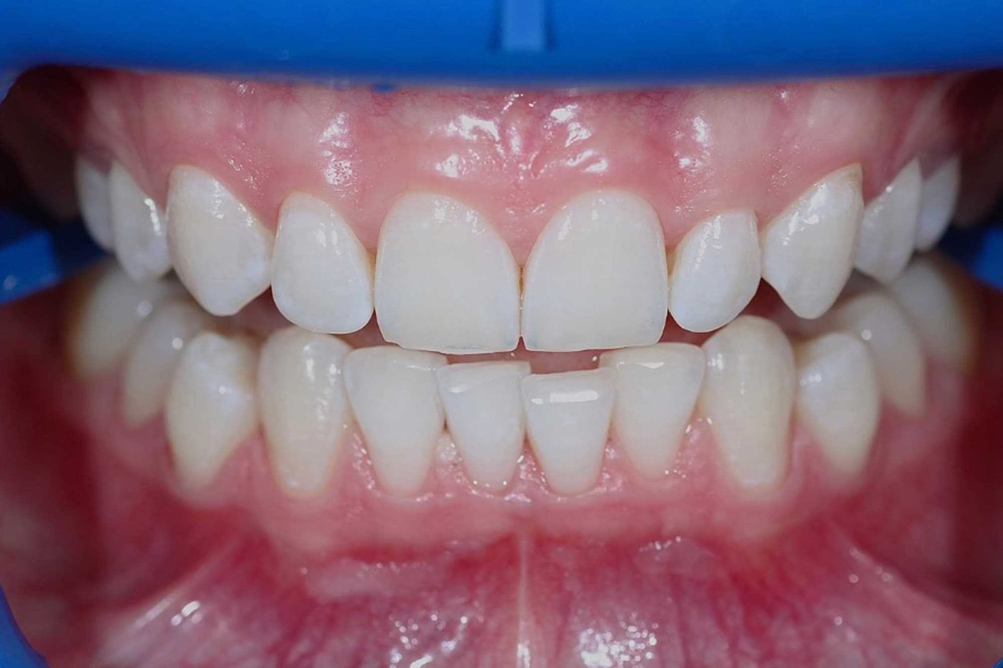 Лазерное отбеливание после