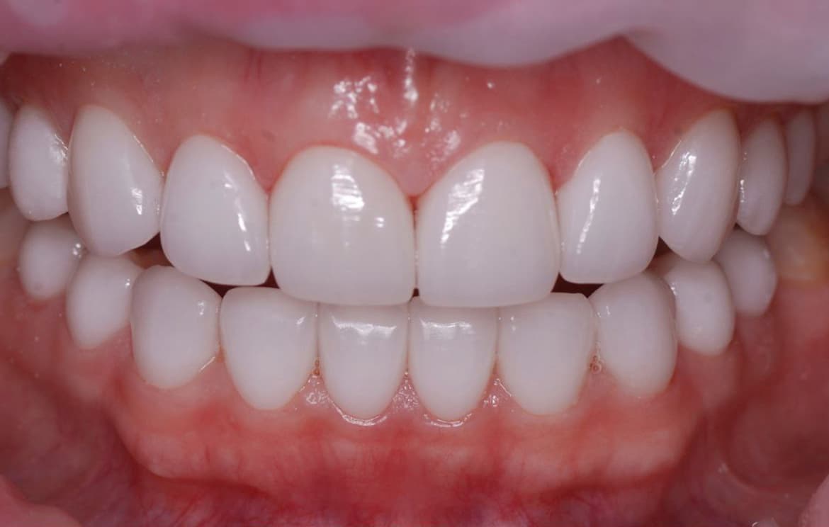 Виниры после установки