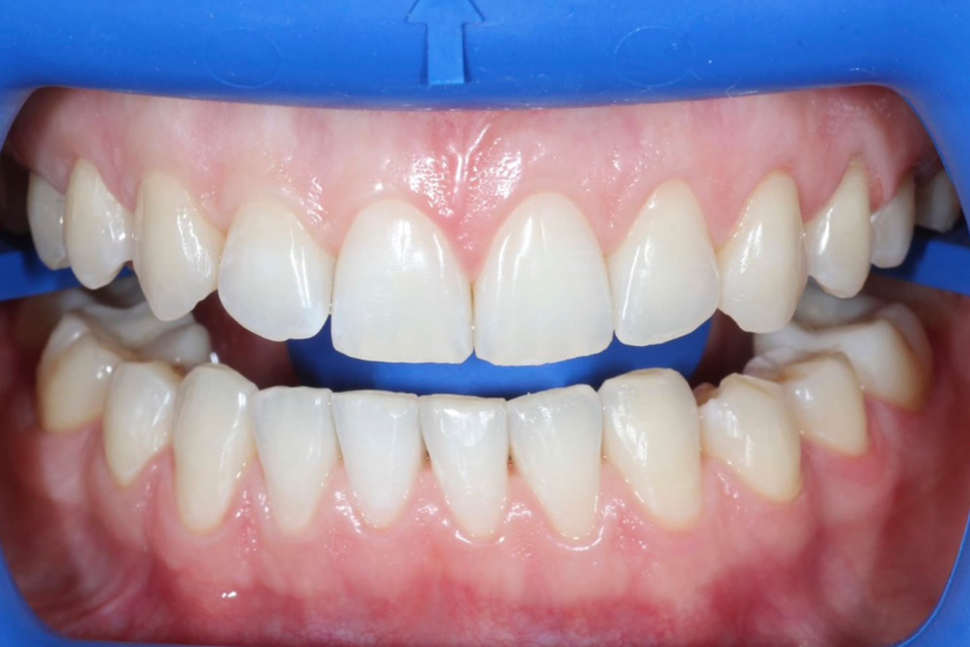 Zoom 4 до отбеливания