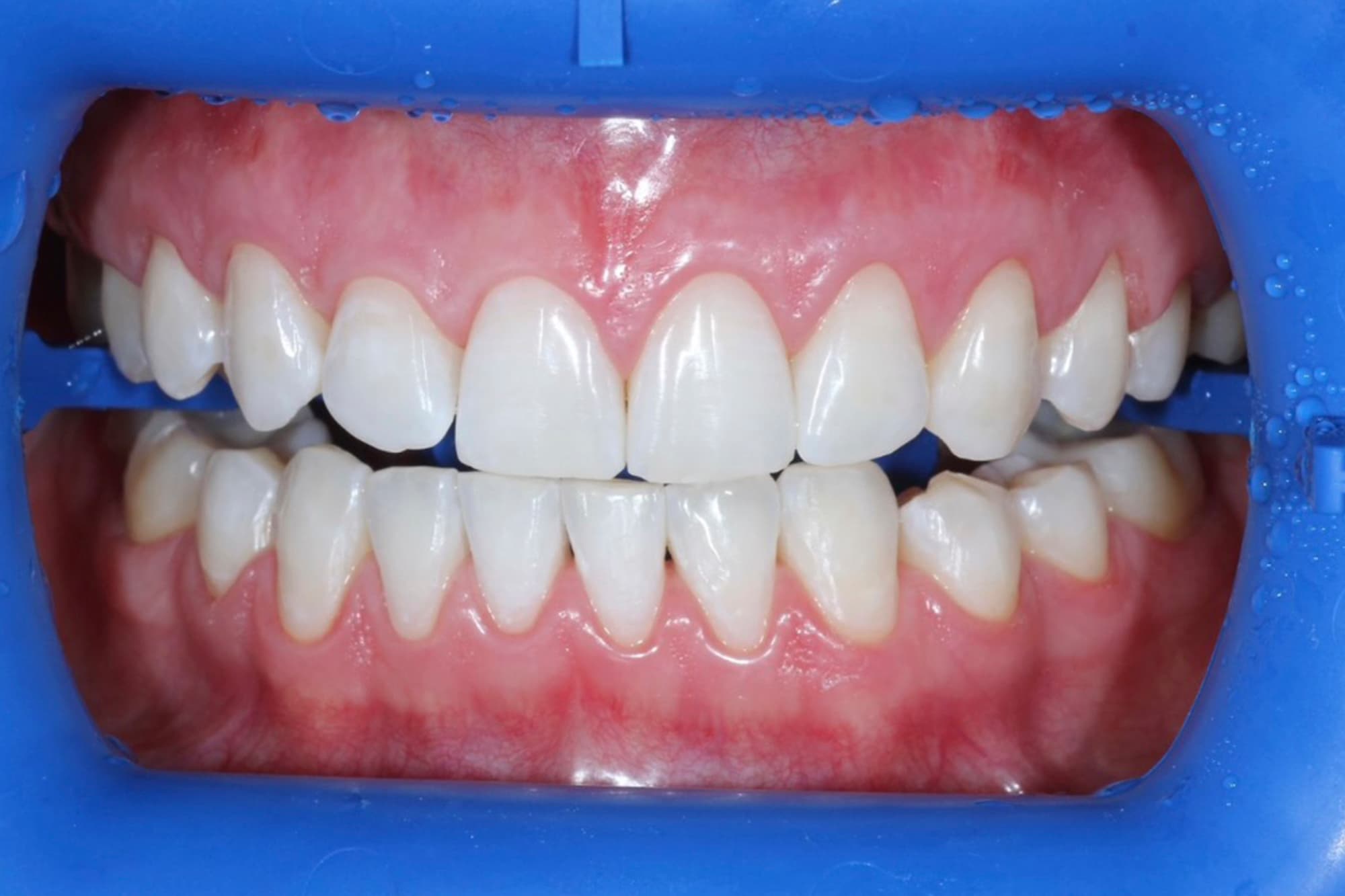 Zoom 4 после отбеливания