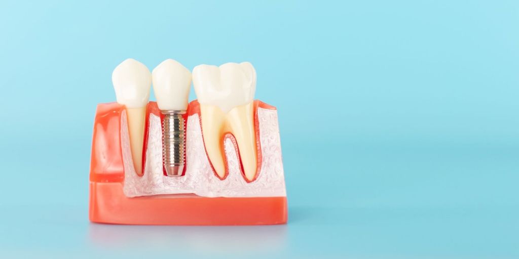 implantaciya-osstem-1.jpg implantaciya-osstem-1.jpg