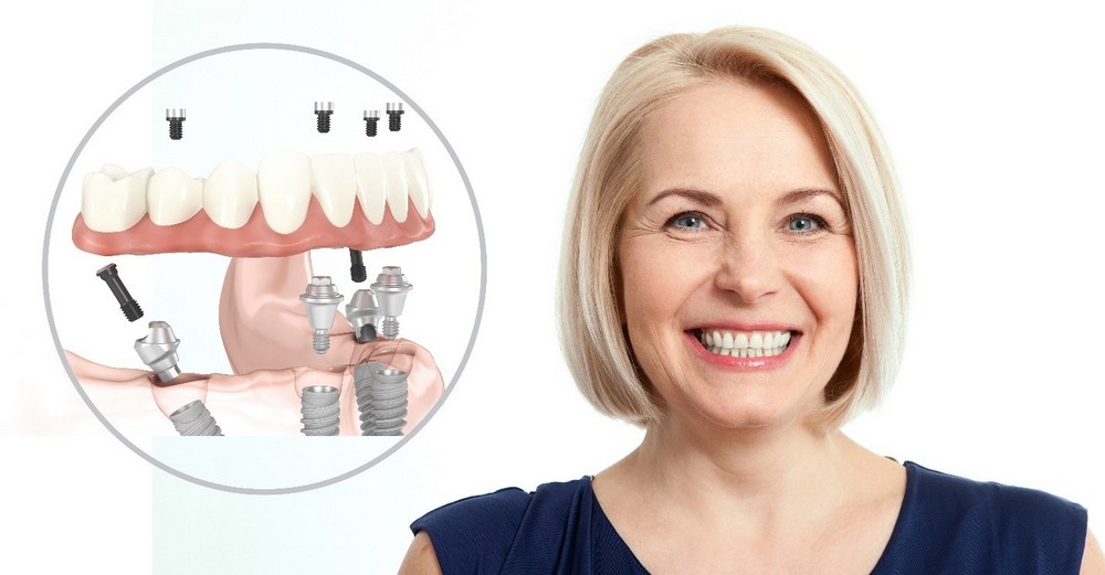 implantaciya-u-zhenschin-6835293.jpg implantaciya-u-zhenschin-6835293.jpg