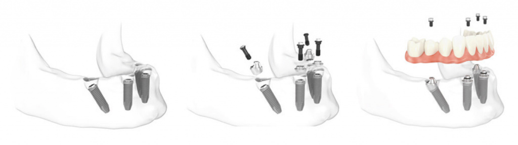 implants@2x.jpg implants@2x.jpg