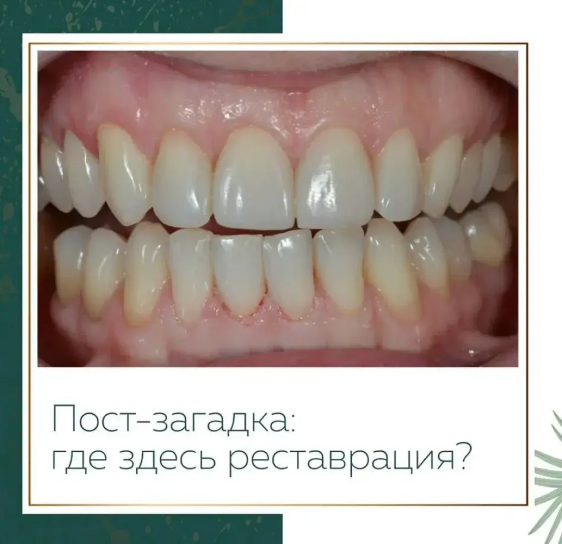 Виниры — изображение 1