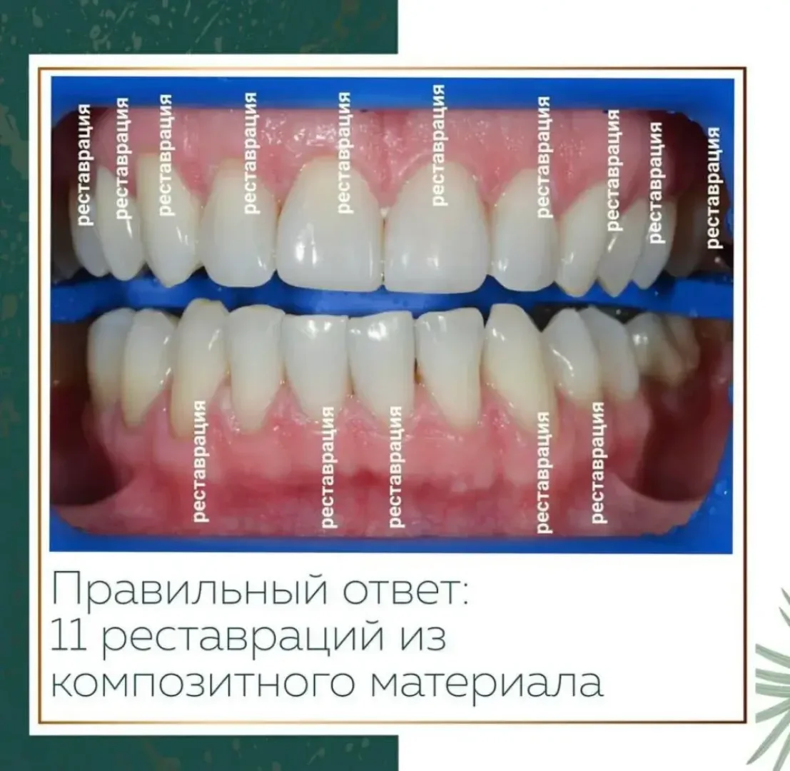 Виниры — изображение 2