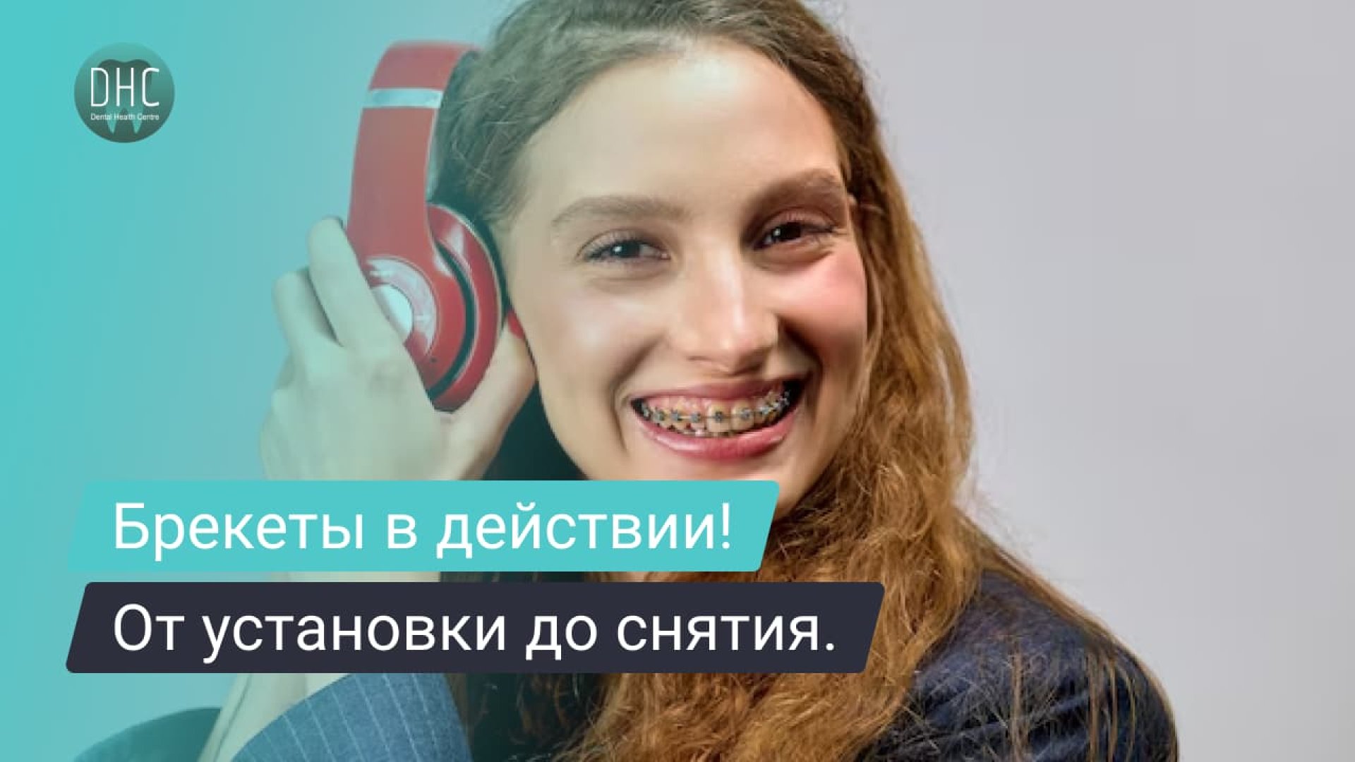 Как работают брекеты: от установки до снятия. hero