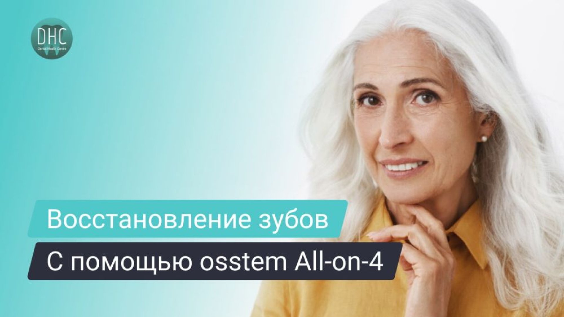 Имплантация зубов на 4-х имплантатах Osstem