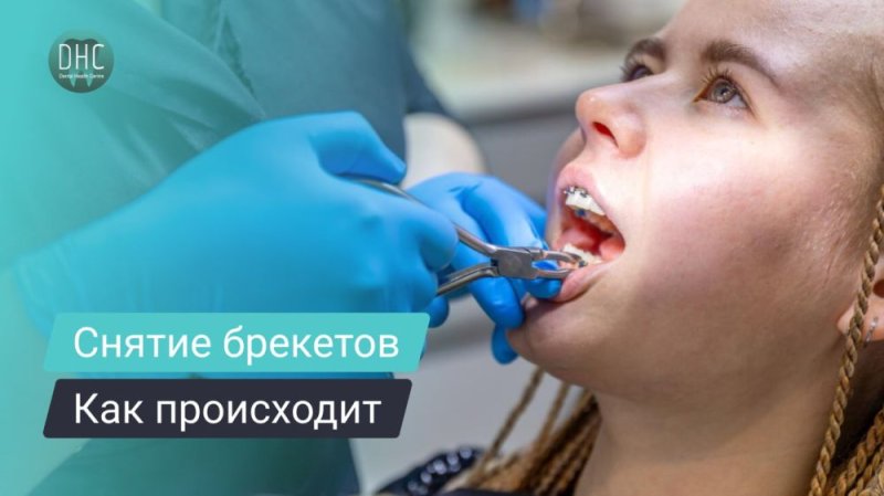 Как происходит снятие брекетов у ортодонта