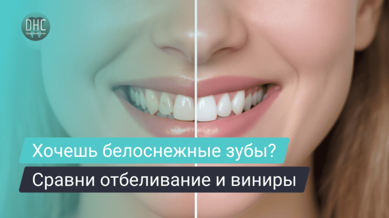 Отбеливание или виниры — что лучше и в каких случаях выбирать