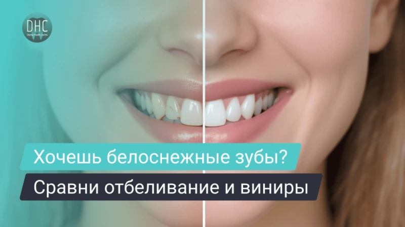 Отбеливание или виниры — что лучше и в каких случаях выбирать