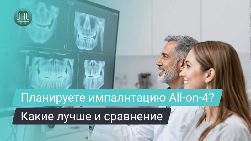 Какие импланты лучше подходят для All-on-4