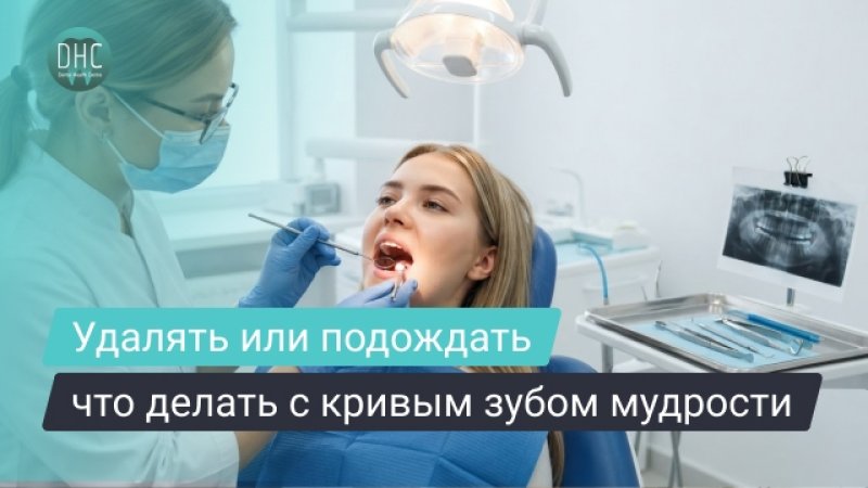 Кривой зуб мудрости: когда нужно удалять, а когда можно наблюдать