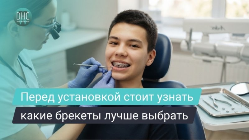 Лигатурные или самолигирующие брекеты: что выбрать и в чем разница