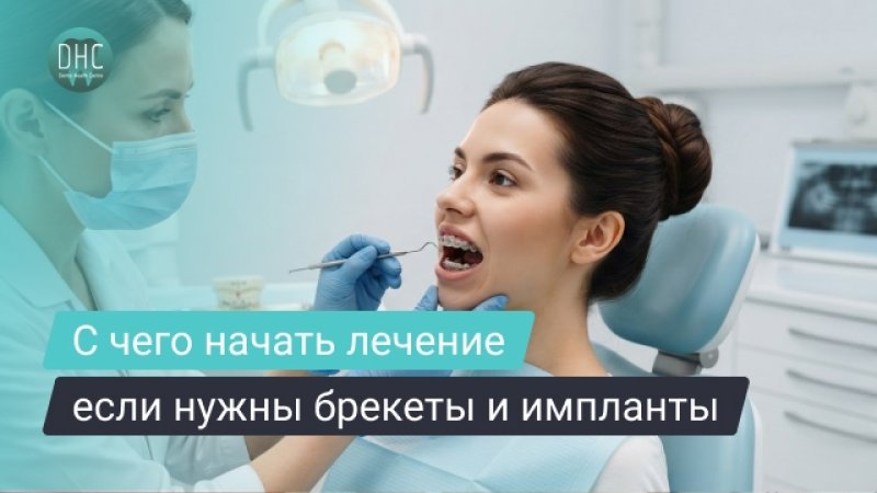 Брекеты и импланты: что ставят сначала и как выбрать правильный порядок лечения