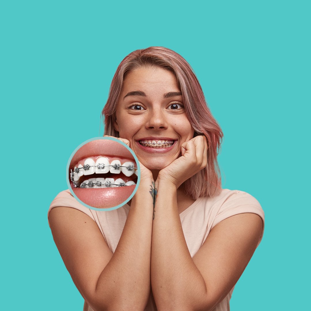 Лечение на брекетах - 14 000 рублей в месяц!  banner