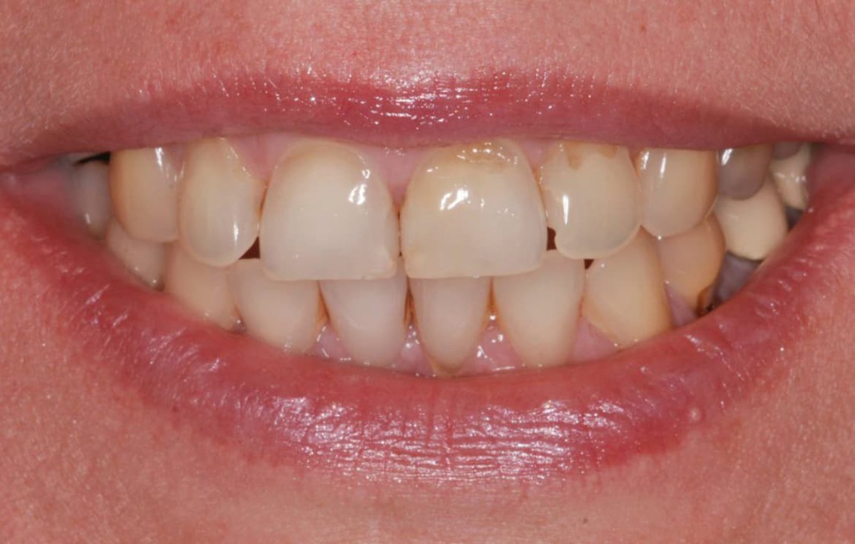 Лечение кариеса трех зубов до