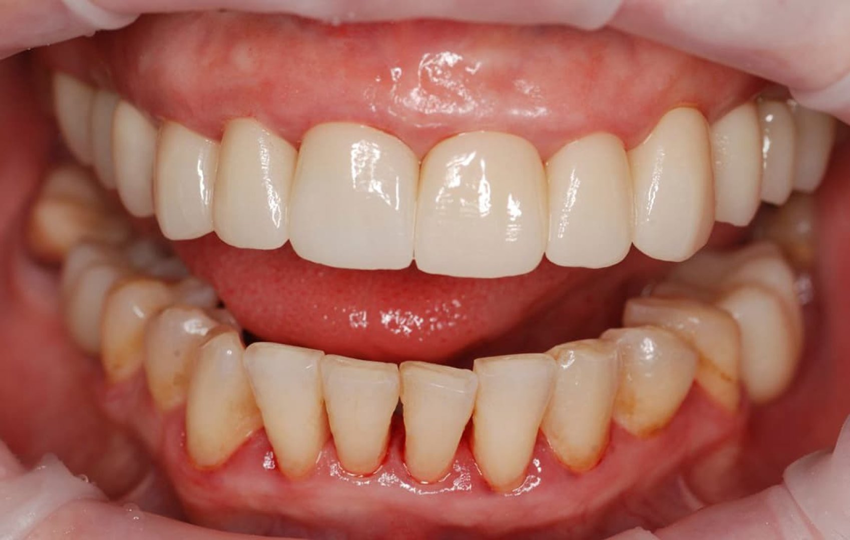 Замена старых коронок на циркониевые с реставрацией