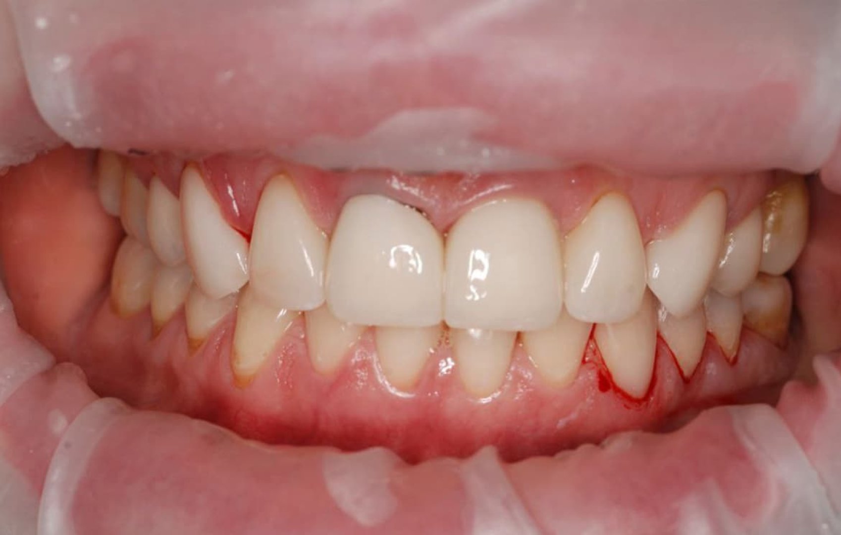 Замена коронок на циркониевые до