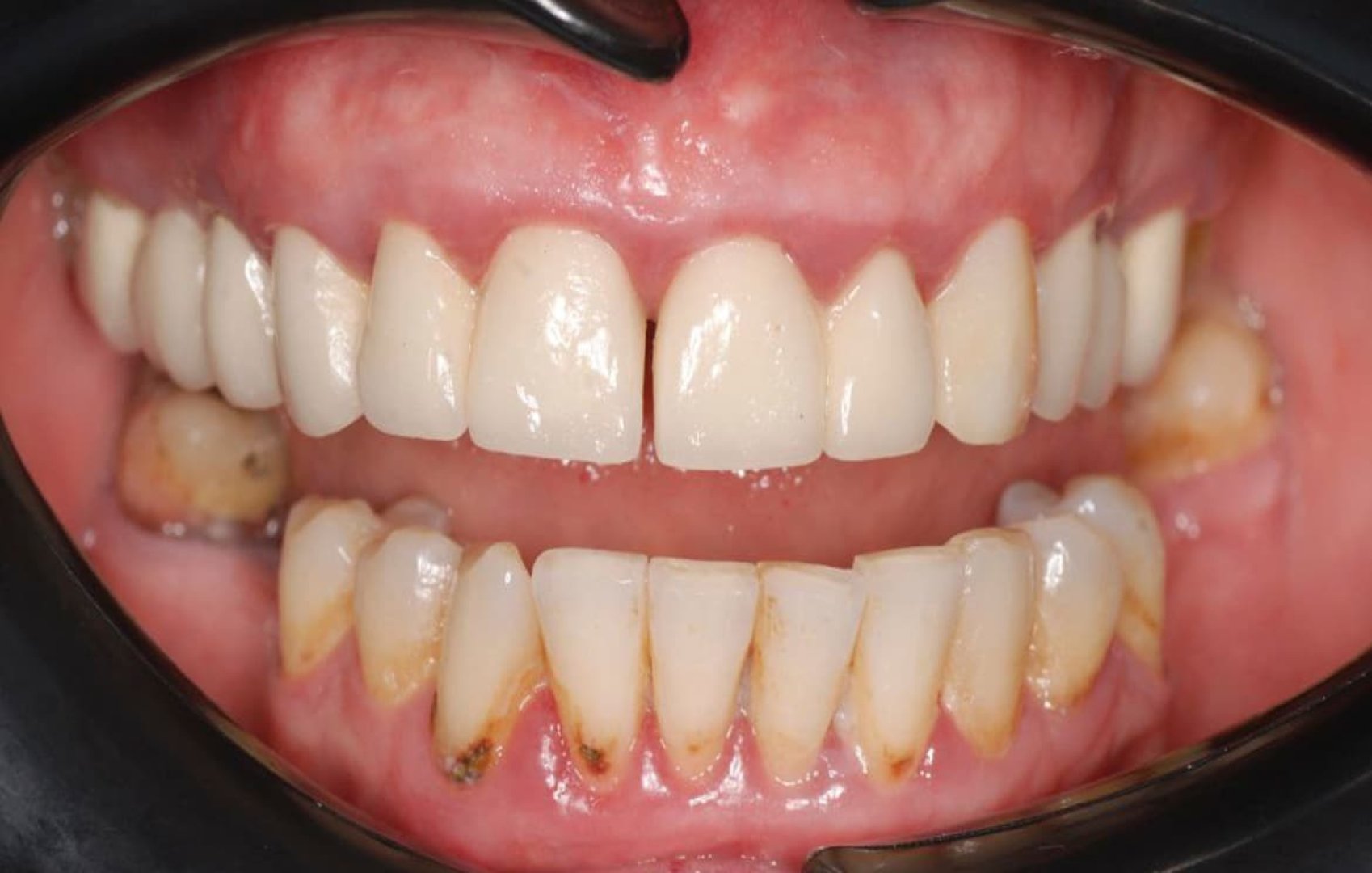 Замена старых коронок на циркониевые с реставрацией до