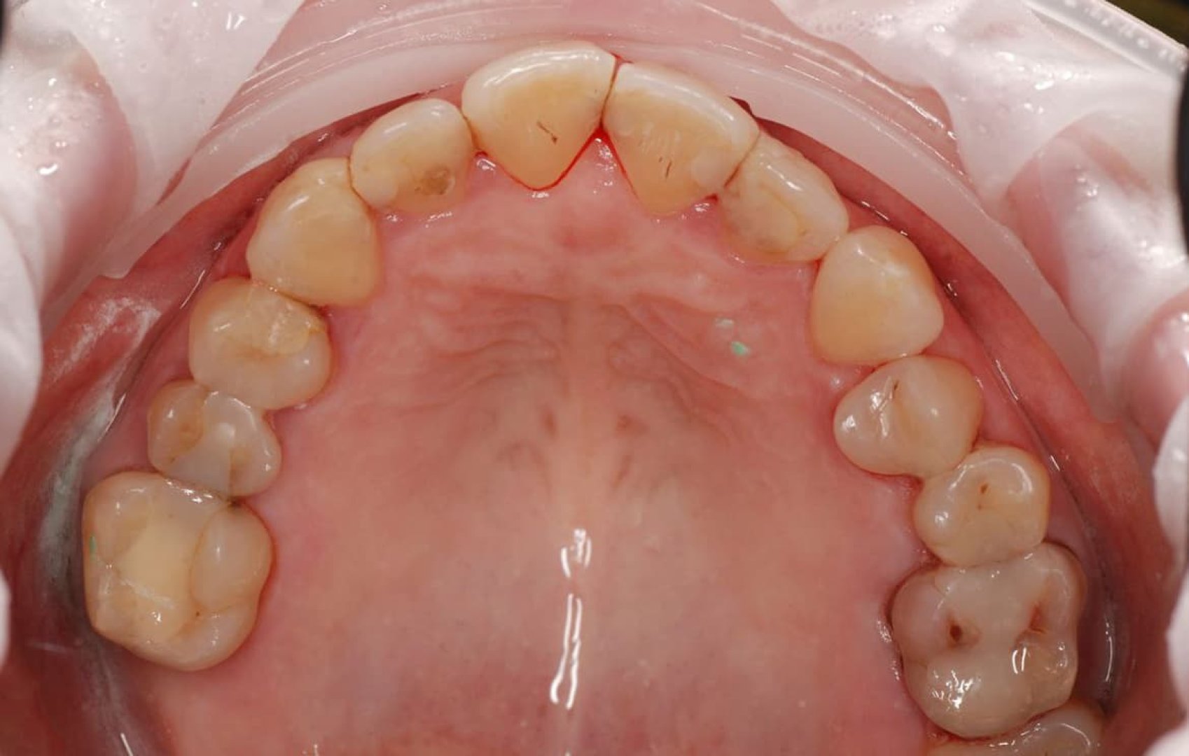 Восстановление зубных рядов реставраций и коронками до