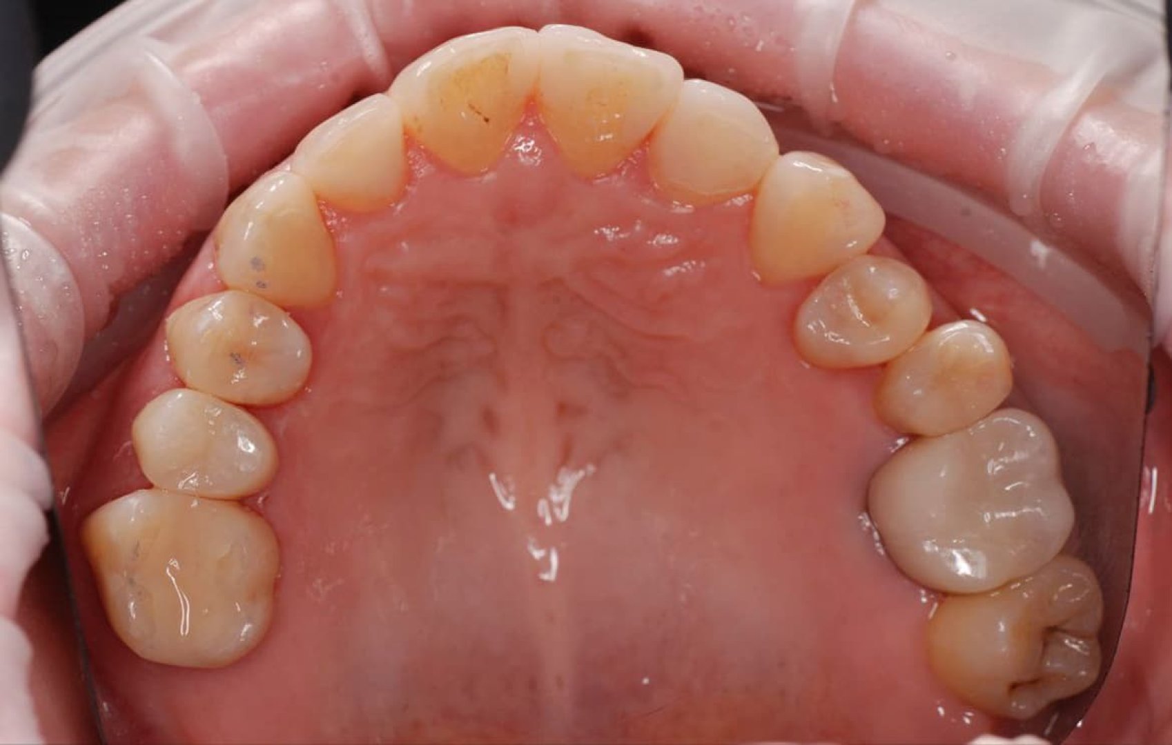 Восстановление зубных рядов реставраций и коронками