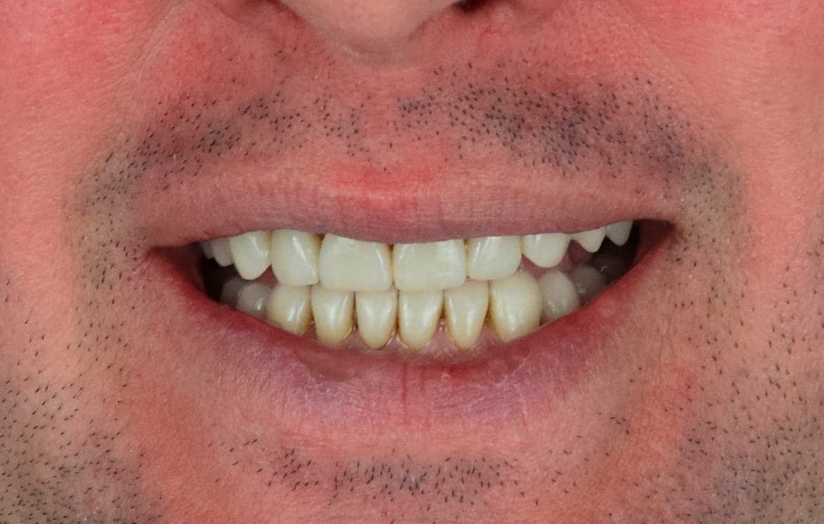 Сплинт-терапия, замена старой керамики до