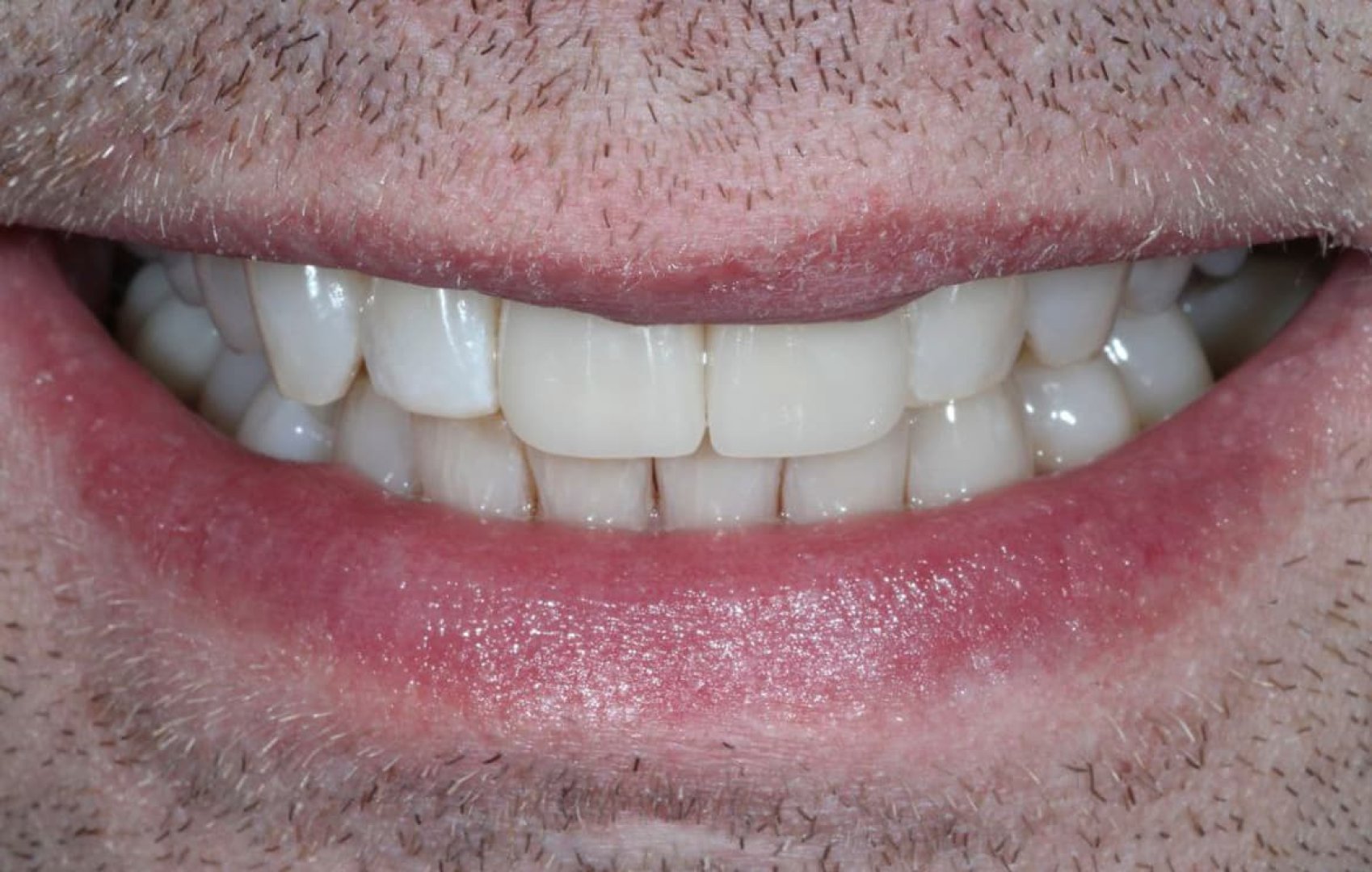 Виниры и отбеливание.