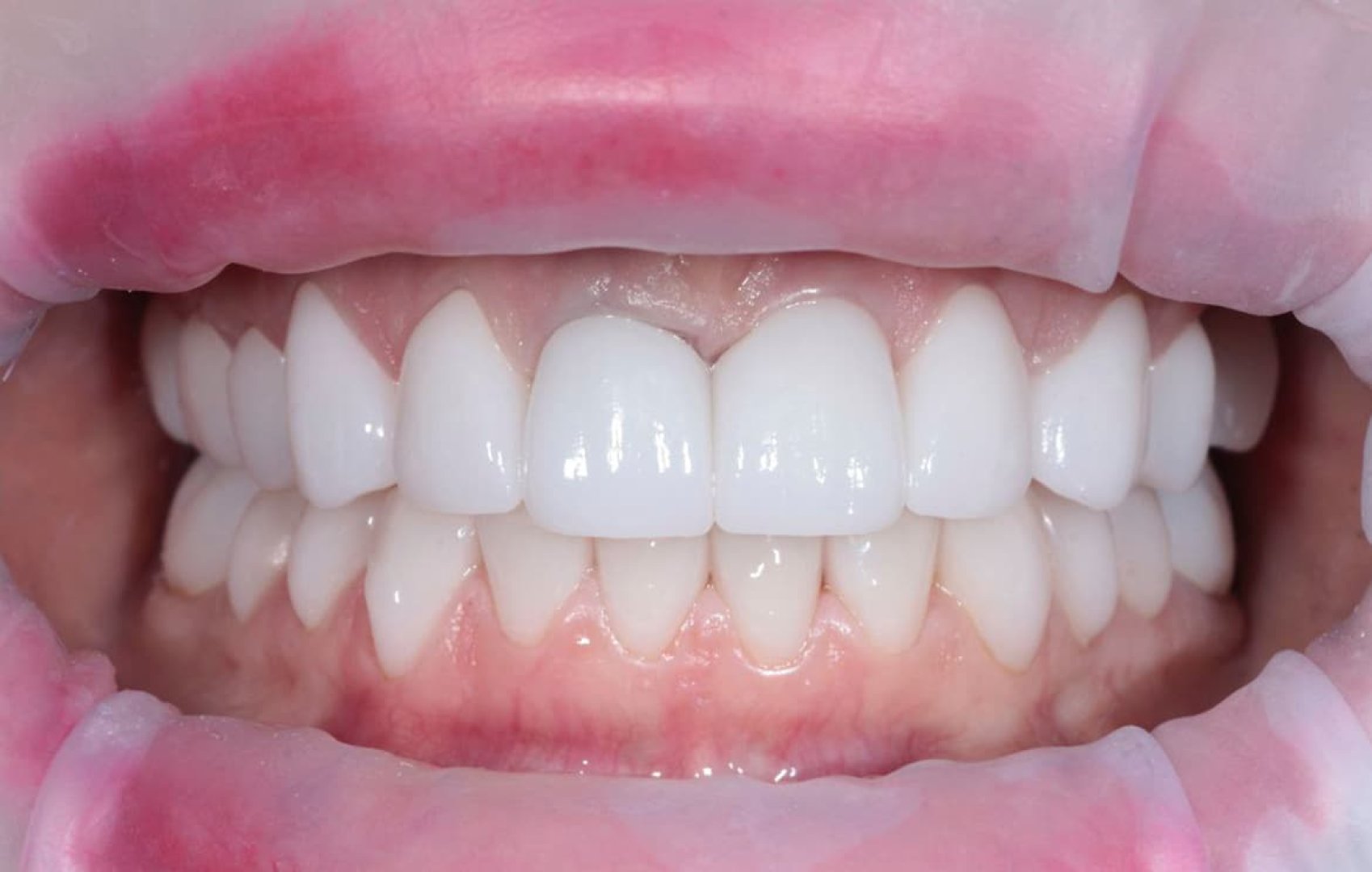 Замена коронок на циркониевые