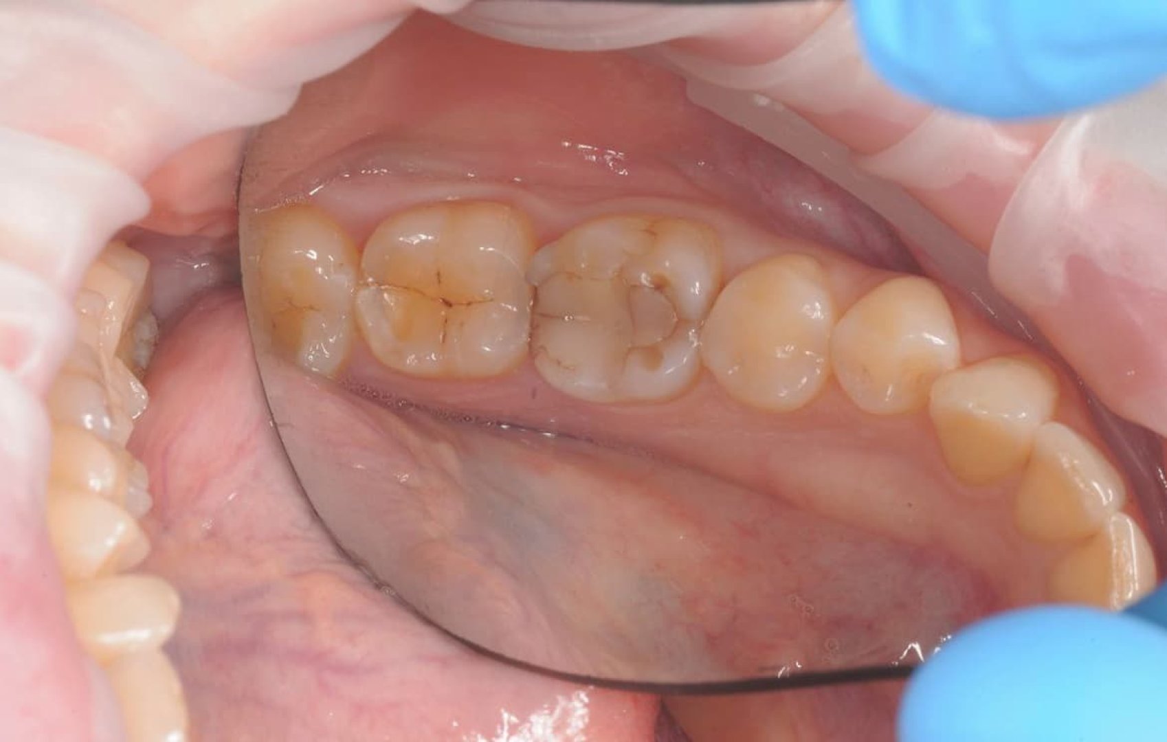 Керамическая вкладка на нижний зуб до