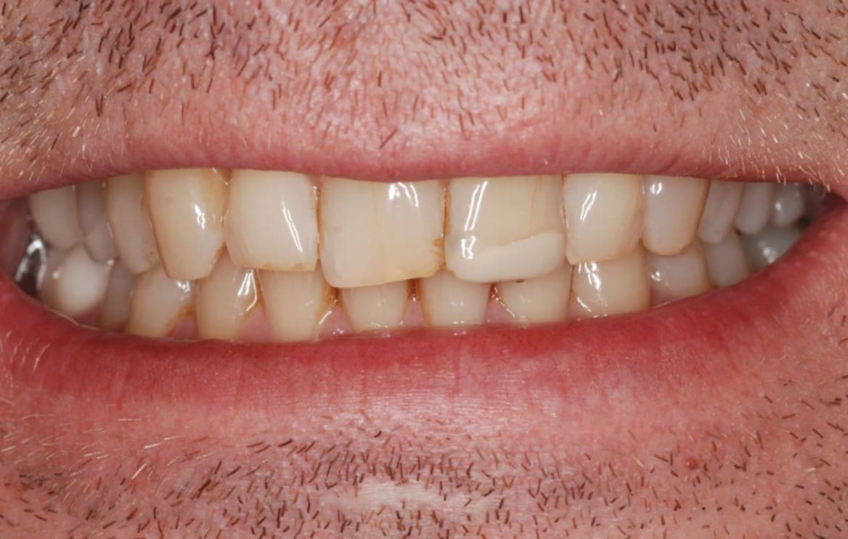 Виниры и отбеливание. до