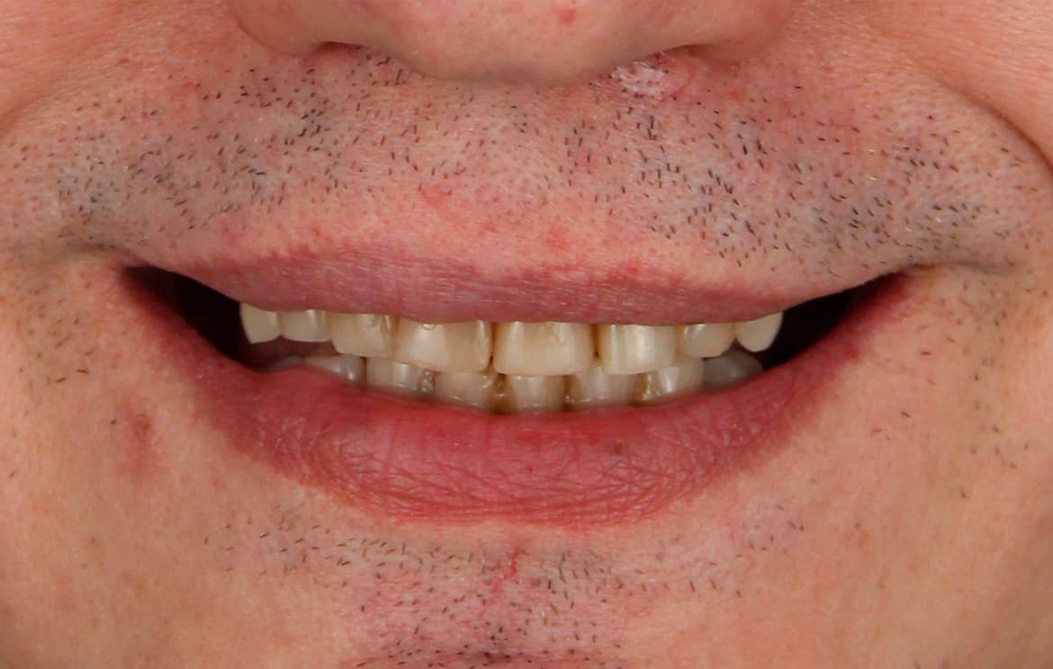 Комплексное лечение и тотальное протезирование до