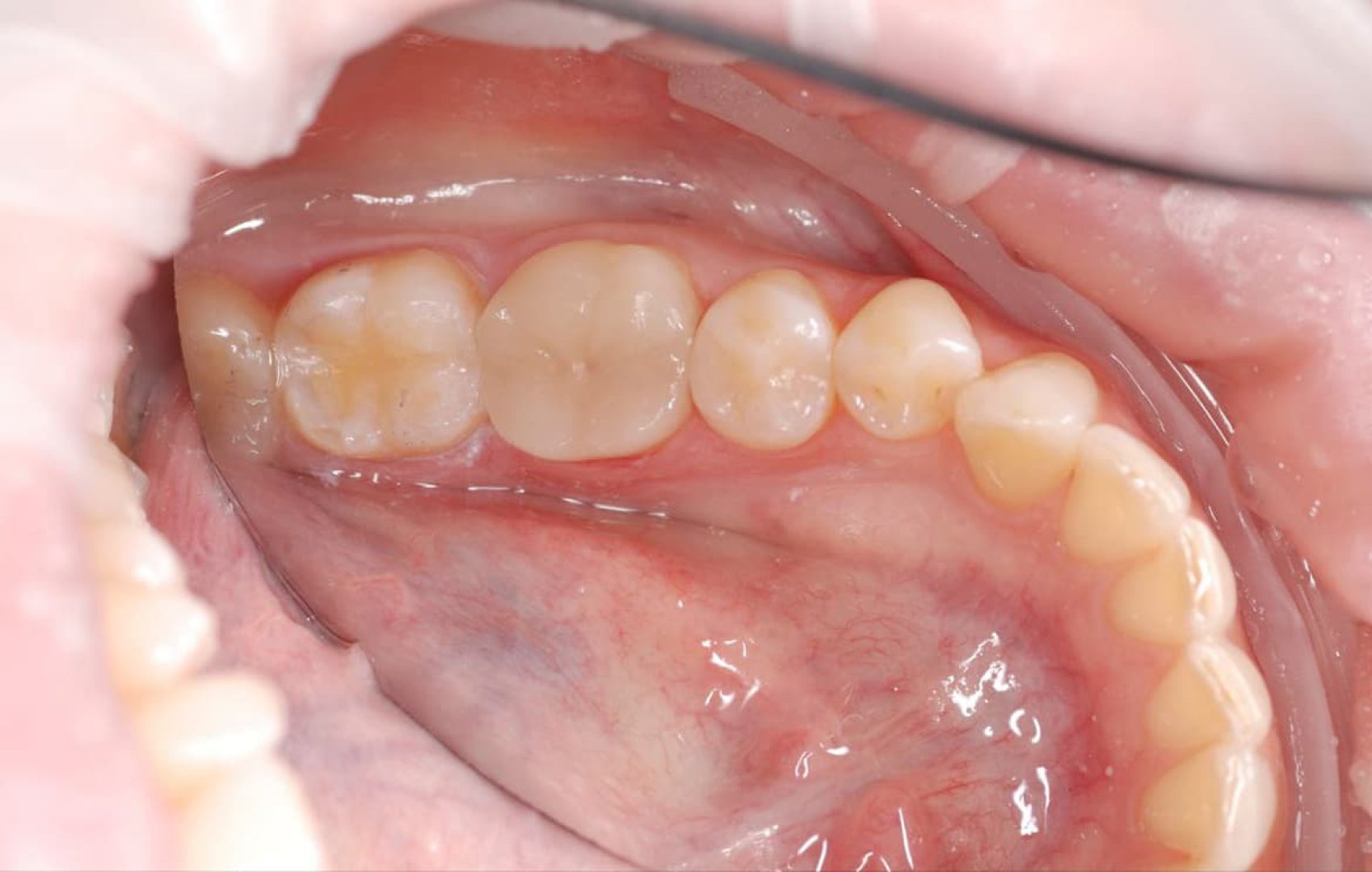 Керамическая вкладка на нижний зуб