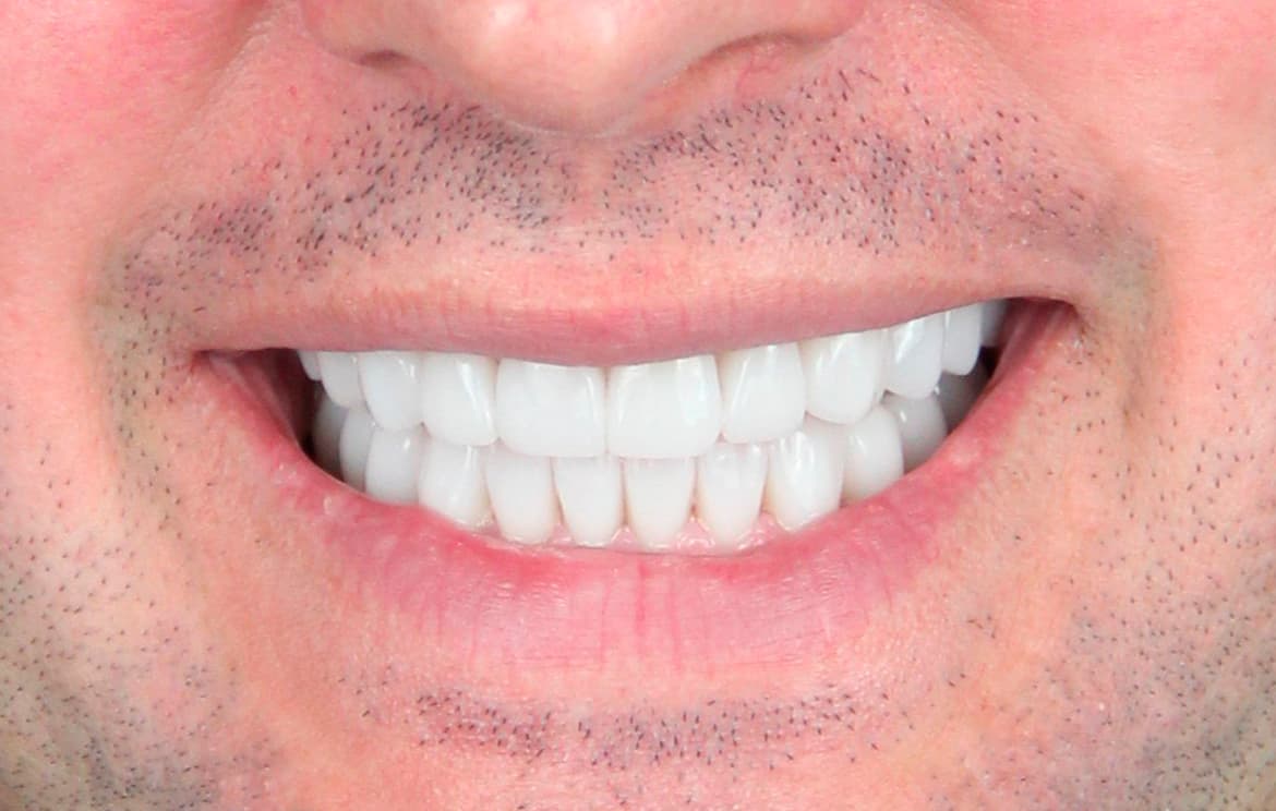 Сплинт-терапия, замена старой керамики после