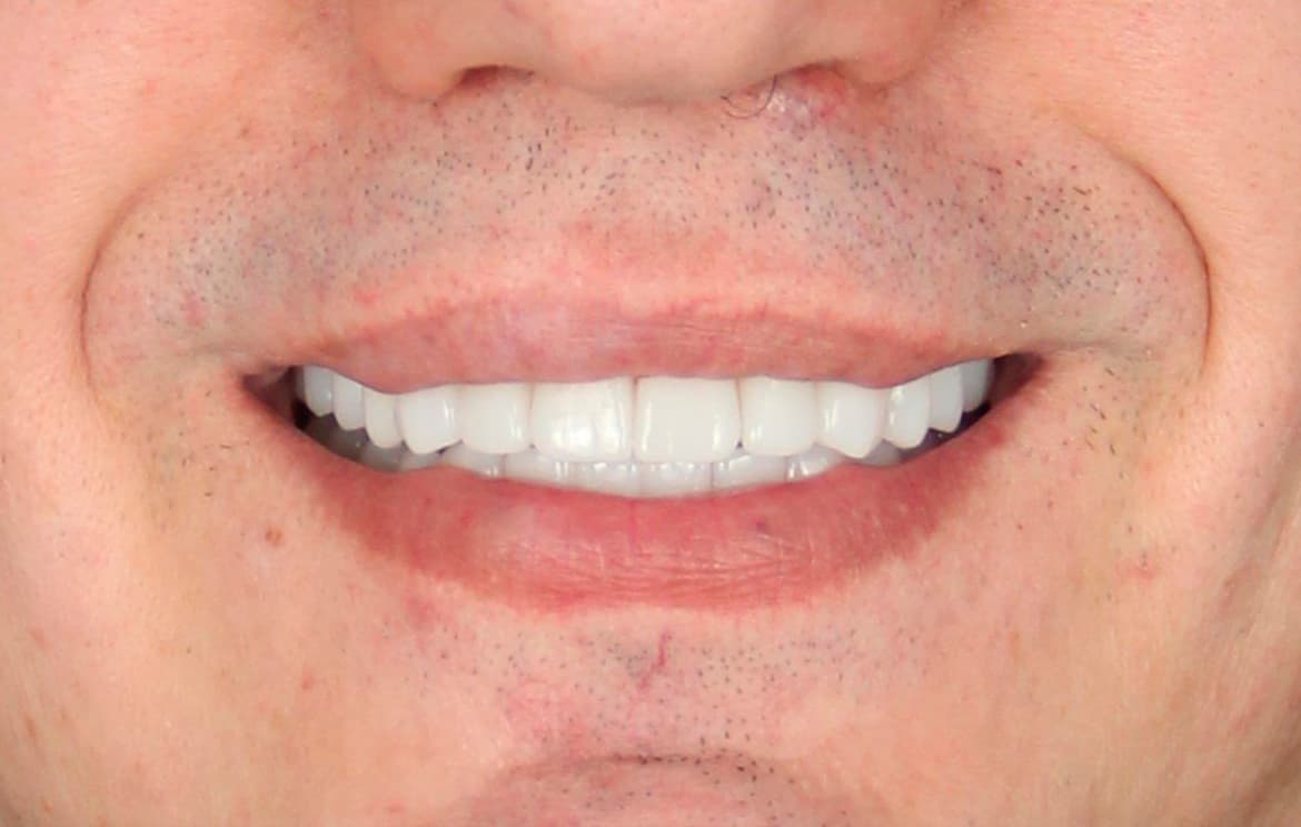 Комплексное лечение и тотальное протезирование после