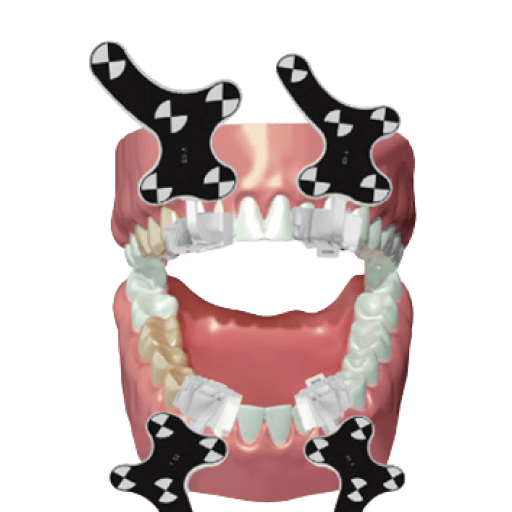 Метки для навигационной имплантации IMPNAV